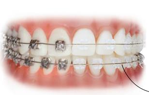 Aparatos fijos de ortodoncia | Recurso educativo 44733
