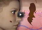 Skin cancer | Virtual experiment | Investigate a suspect skin growth | Recurso educativo 688456